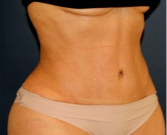 Feel Beautiful - Liposuction Flanks 215 - After Photo